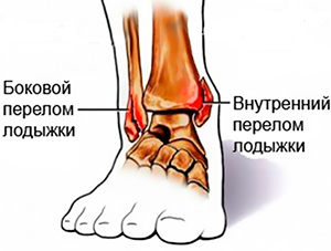 Диета После Перелома Лодыжки