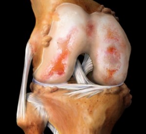 Алмаг-01 для лечения артроза коленного сустава