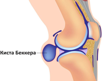 Лечение кисты коленного сустава алмагом thumbnail