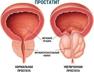 Prostatitis guskov módszer