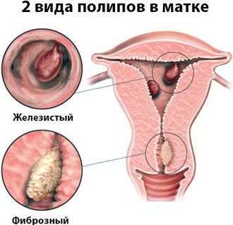 Магнитотерапия при полипах