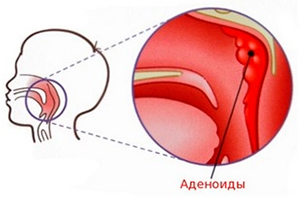 Галотерапия при аденоидах