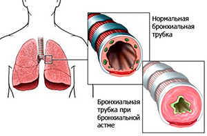Галотерапия при бронхиальной астме