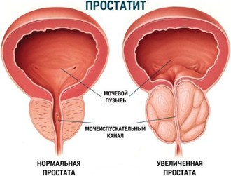 Лазеромагнитотерапия при простатите