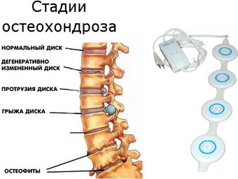 Магнитное лечение остеохондроза позвоночника