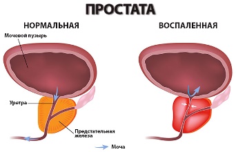 Магнитное лечение простатита