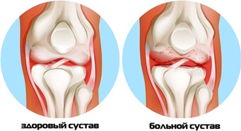 Магнитное лечение суставов