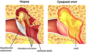 Магнитотерапия на ухо при отите