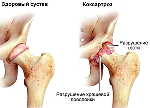 Магнитотерапия при артрозе тазобедренного сустава