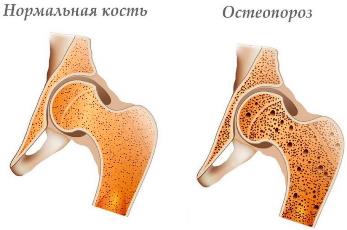 Магнитотерапия при остеопорозе