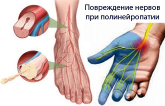 Магнитотерапия при полинейропатии