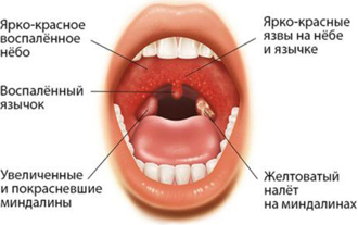 УВЧ-терапия горла и миндалин